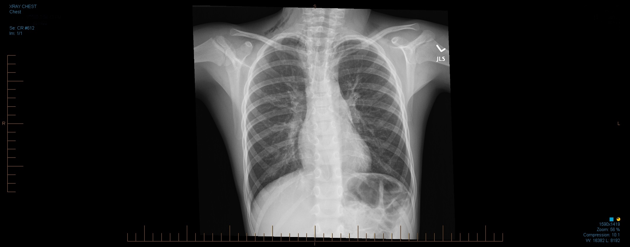Pneumomediastinum.